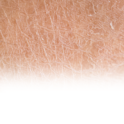 Dry Skin