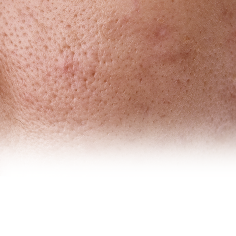 Oily/Combo Skin